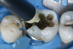 Лечение зубов в Домодедово недорого